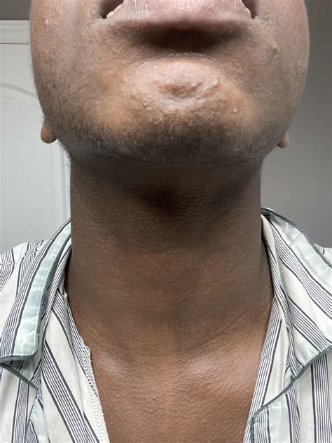 Skin Concern Ive Had These Little Bumps On My Chin For Years Now