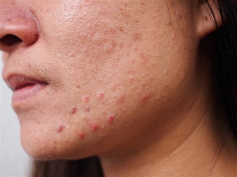 Is It Possible To Get Rid Of Acne Rosacea Balmonds