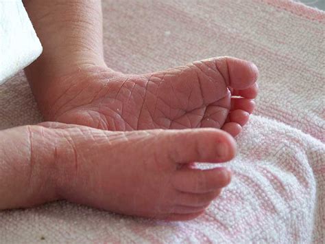 Skin Peeling On Your Newborn Baby How To Help Their Dry Skin