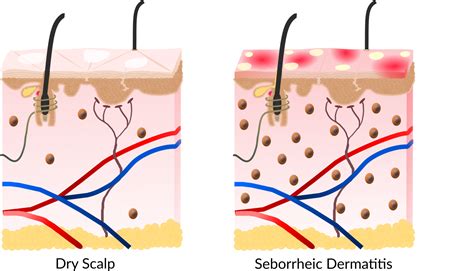 The former, a skin condition known as dandruff, is just as. itchy scalp | AntalGenics