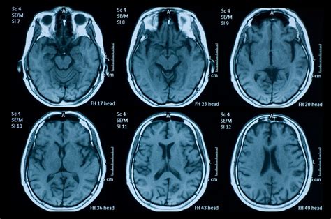 Brain Mri And Eeg Clues To Covid 19 Related Encephalopathy