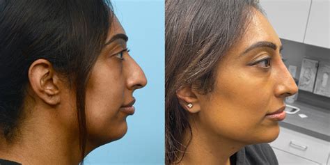 Rhinoplasty Before And After Asli Tarcan Clinic