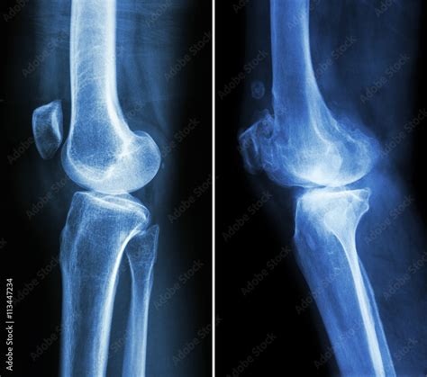 Normal Knee Left Image And Osteoarthritis Knee Right Image