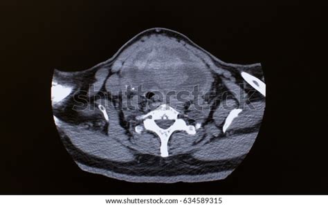 Sagittal View Ct Scan Neck Showing Stock Photo Edit Now 634589315