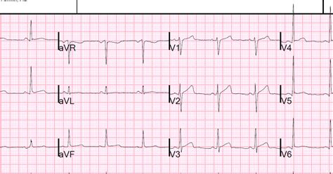Dr Smith S ECG Blog Is It Wellens Syndrome