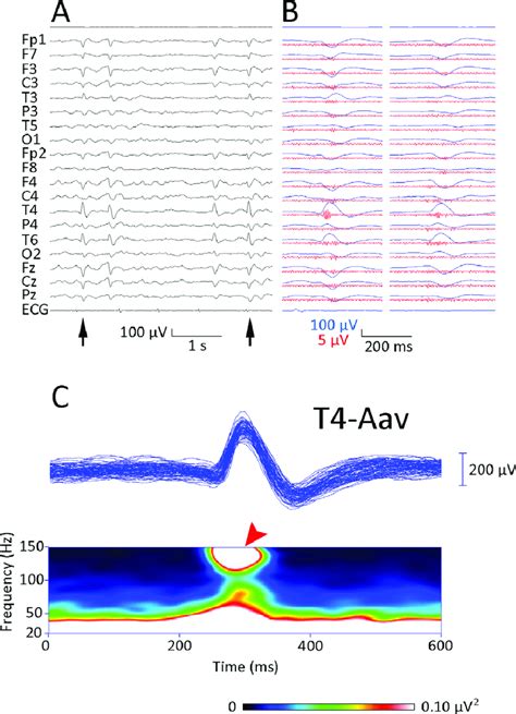 Representative Eeg Data Recorded From A Patient With Benign Epilepsy
