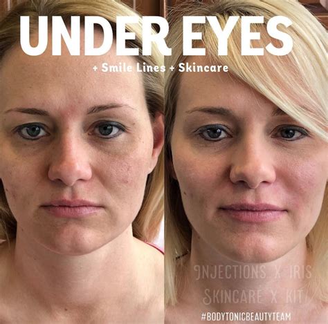Dermal Filler Placed Under The Eyes Diminishes Dark Circles And Bags