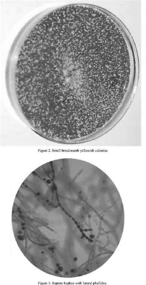 Figure 3 From Subcutaneous Facial Mycosis In A Child Due To Madurella