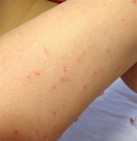 Rashes That Look Like Scabies Causes Symptoms And Tre Vrogue Co