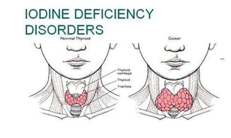 How Does Iodine Deficiency Impact The Thyroid Fitpaa