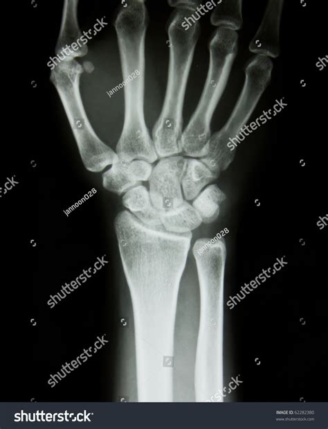 Xray Human Hand Wrist Stock Photo 62282380 Shutterstock