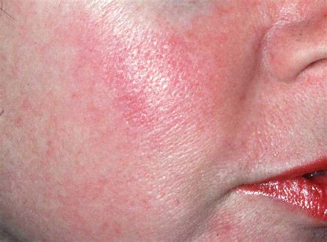 Types Of Rosacea Facial Redness Erythema—the Medical Term Flickr