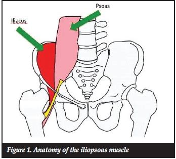 Iliopsoas Tendonitis After Hip Replacement Doctorvisit