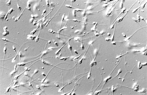 Lo spermiogramma o analisi del liquido seminale rappresenta il cardine dell'iter diagnostico finalizzato alla valutazione della fertilità maschile. Spermiogramma (Esame del liquido seminale) - Centro Clinico San Carlo