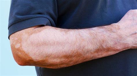 Vitiligo Signs And Symptoms Everyday Health