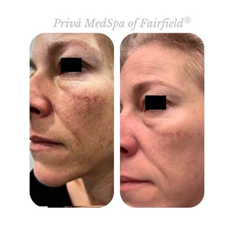 Patient 146898755 Ipl Spot Treatment Before And After Photos
