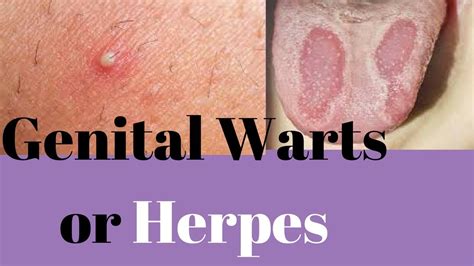 genital warts or herpes similarities and differences of genital warts and herpes youtube