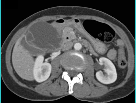Gallbladder Abscess Liver Case Studies Ctisus Ct Scanning