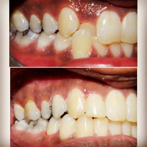 Don't think your child needs crossbite correction? 12 months of braces can fix crossbite and crowding like ...