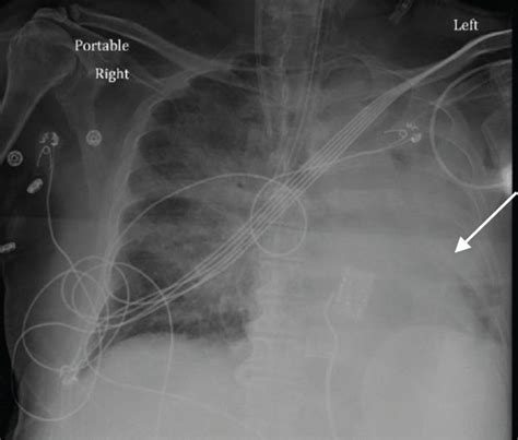 A Chest Radiograph Showing Small Right Pleural Effusion On Admission