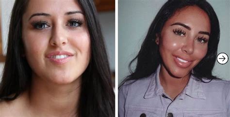 20 Before And After Images Of Girls With Lip Fillers