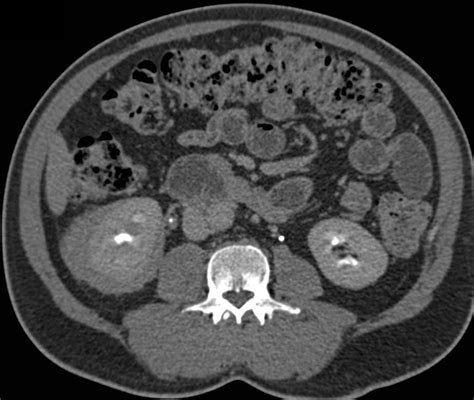 Renal Lymphoma With Perirenal Involvement Kidney Case Studies