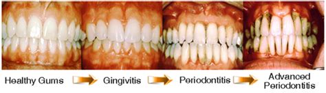 Difference Between Gingivitis And Periodontitis