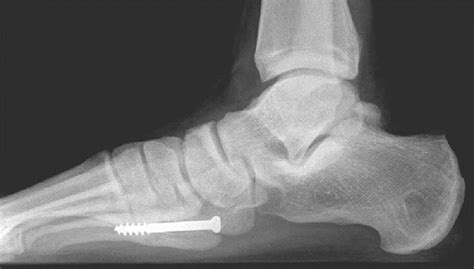 5th Metatarsal Base Fracture Foot And Ankle Orthobullets