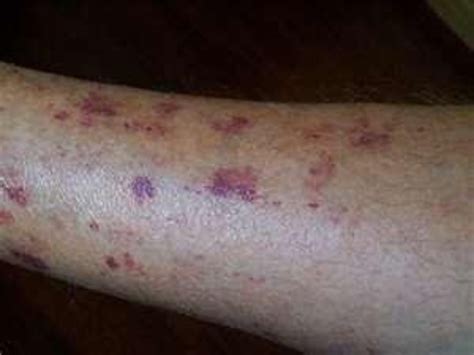 Causes Of Senile Purpura Information And Symptoms Of Senile Bleeding Or Bruises Hubpages