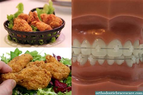 Can I Eat Chicken With Braces 7 Easy Ideas Orthodontic Braces Care