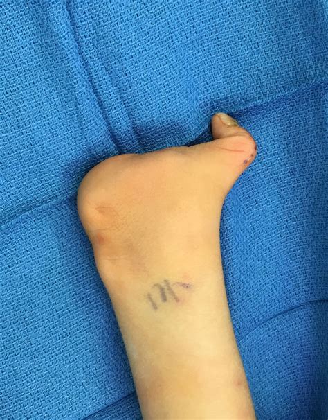 Simple Surgery For Symbrachydactyly Congenital Hand And Arm Differences