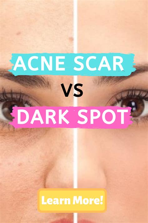 Pin On Acne Tips