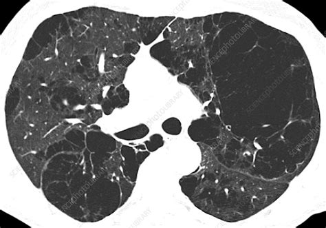 Emphysema Lung Disease Axial Ct Scan Stock Image C0486073