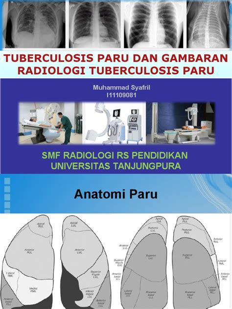 Gambaran Radiologi Tb Paru