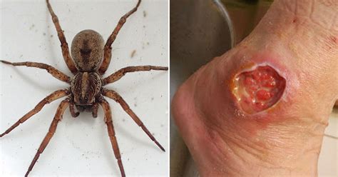 Brown Recluse Spiders Brown Recluse Spider Bite Brown Recluse Spider Images And Photos Finder