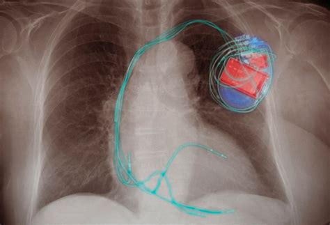 Implantable Cardioverter Defibrillator Complications