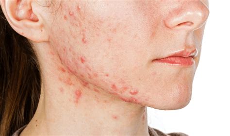 Fungal Acne Symptoms And Treatment Lifestyleabout