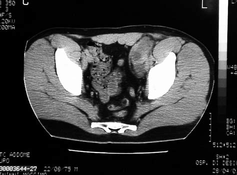 Ct Scan Showing Bulk Disease Of Pelvic Lymph Nodes On The Left Side