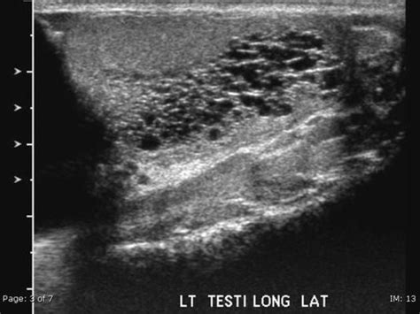 Looking for online definition of mediastinum testis in the medical dictionary? Pin on Urogenital Radiology