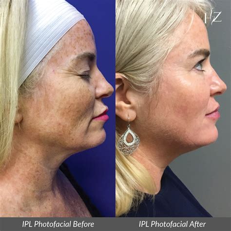 ipl photofacial before and after ipl photofacial photofacial plastic surgery