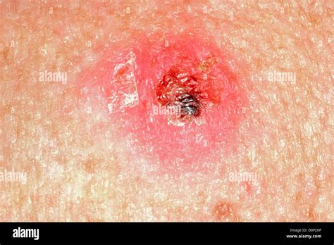 A Lump That Bleeds Or Develops A Crust May Indicate Skin Cancer Stock