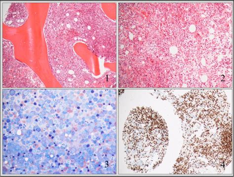 Bone Marrow Histology Images 1 2 And 4 And Cytology Image 3