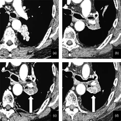 Early Detection Of Recurrent Lung Cancer Enhancing Nodule In Post
