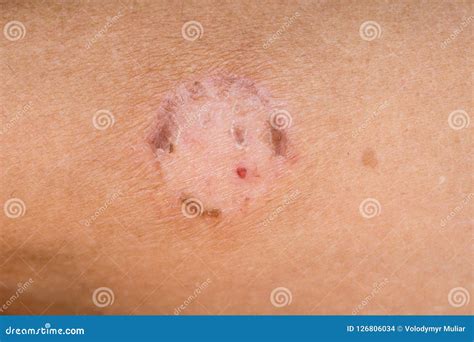 Herpes On The Skin Of Man Infectious Skin Disease Stock Photo Image