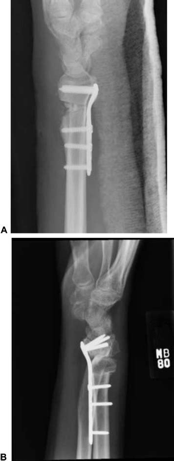 Complications Of Corrective Osteotomies For Extra Articular Distal