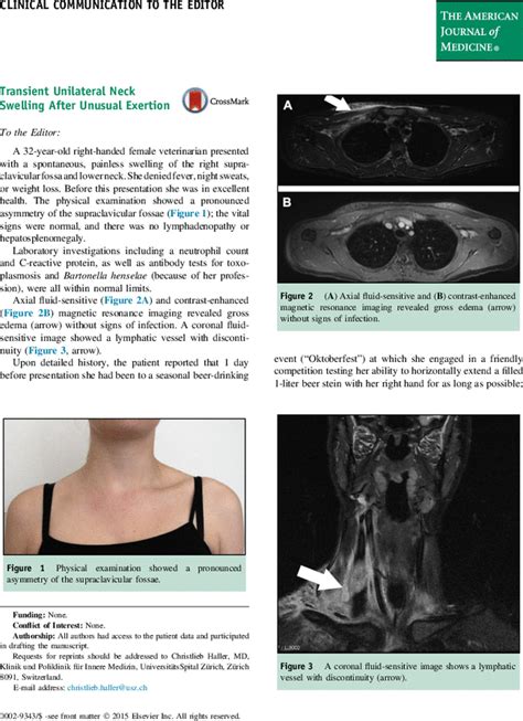 Transient Unilateral Neck Swelling After Unusual Exertion The