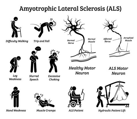 13 Early Warning Signs And Symptoms Of Als Amyotrophic Lateral Sclerosis