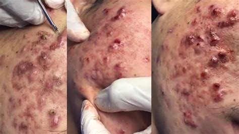 Cystic Acne Blackhead Extraction And Whiteheads Removal Youtube