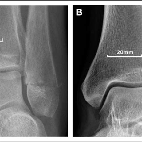 A Mortise View Ankle Plain Radiographs Demonstrating A Larger