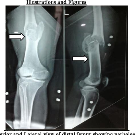 Figure 1 From Pathological Fracture Through Latent Unicameral Bone Cyst
